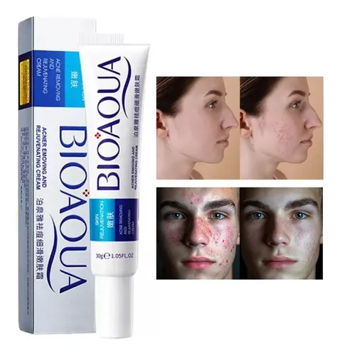 CREMA DE ACNE 